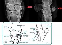 Halla knee calcification